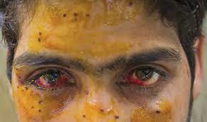 Pellet binds Markundal resident by one eye
