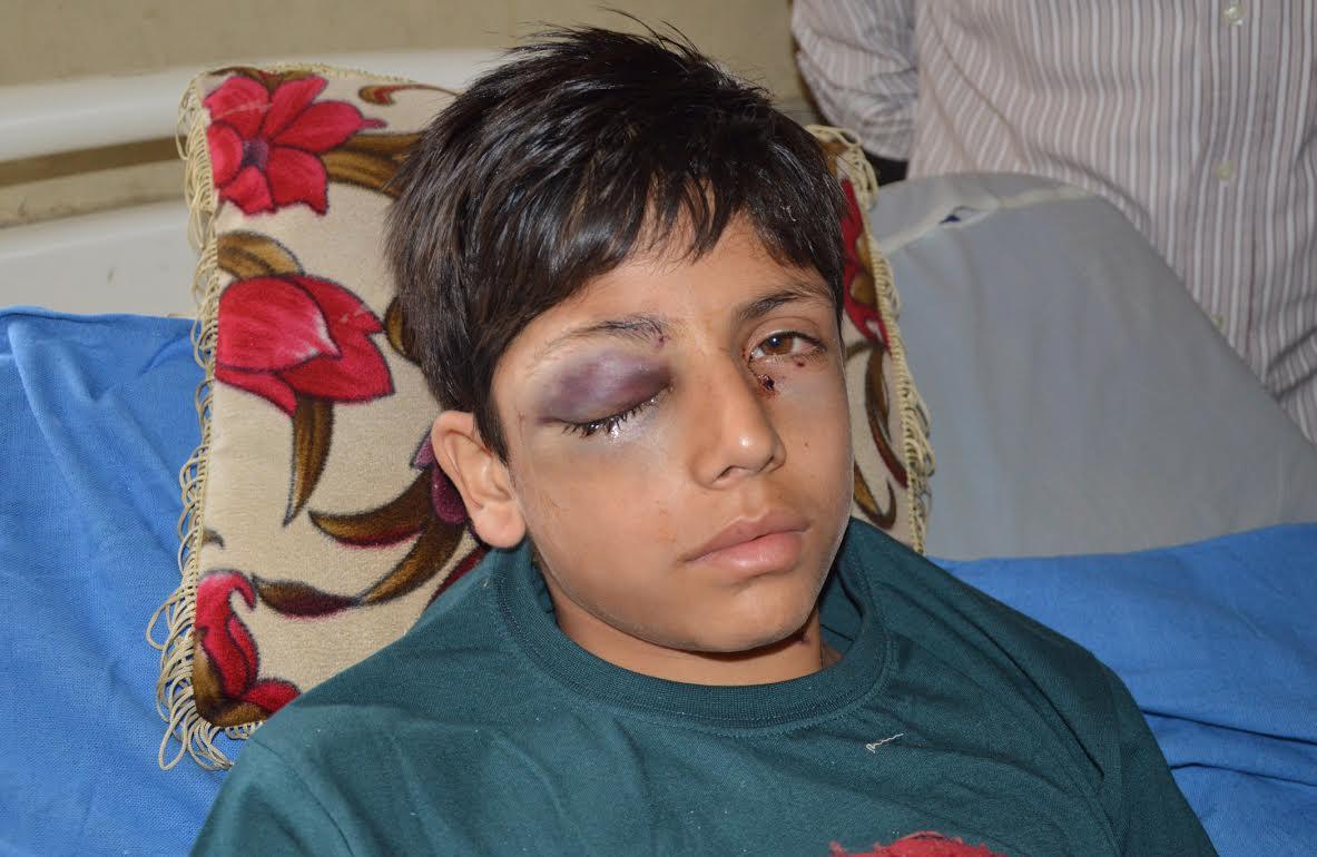 Day 86: Pellets return to haunt again, many injured in clashes