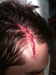 Pulwama salesman sustain injuries after gaseous beverage bottles explode