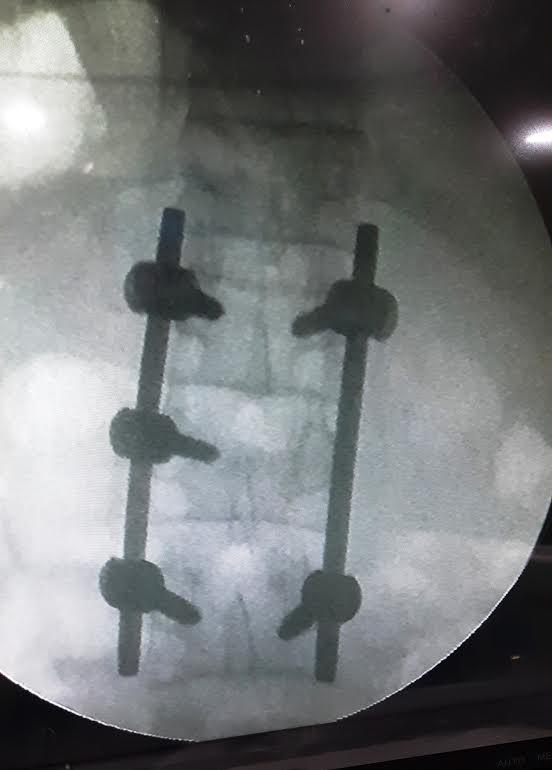First Spinal Surgery Conducted In Islamabad Hospital