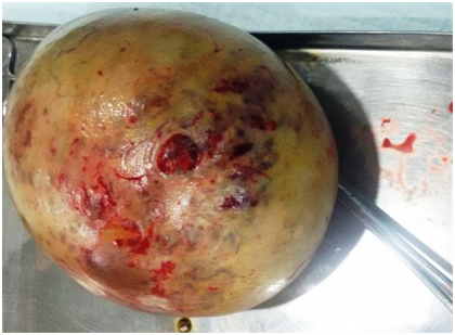 Huge size ovarian cyst removed from a pregnant lady