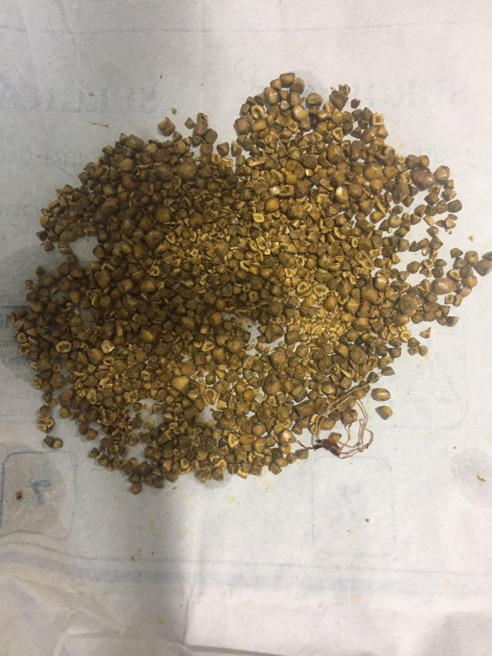 982 Gall Bladder stones removed from a 120kg morbidly obese patient