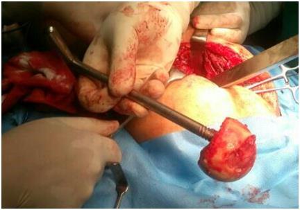Hip replacement done at SDH Kreeri