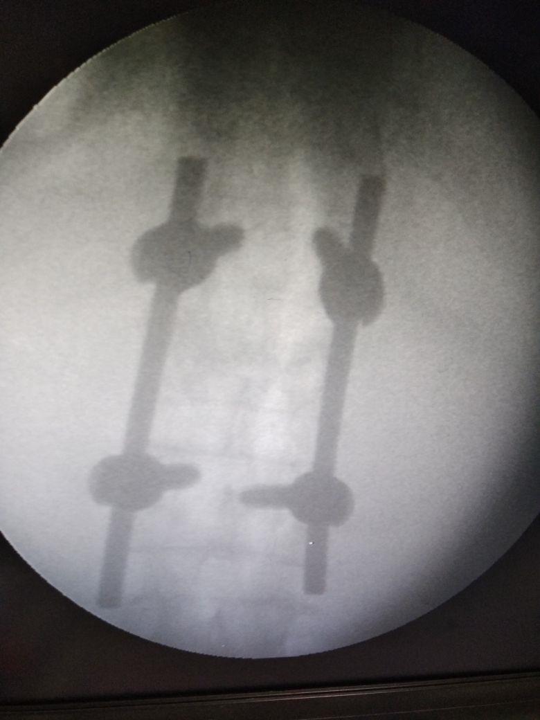 For the first time, Spine surgery performed in north Kashmir