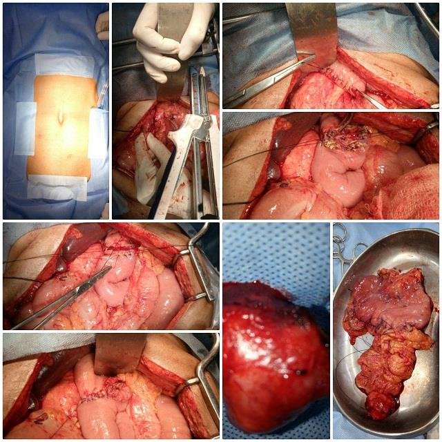 First of its kind, SDH Anantnag performs cancer surgery