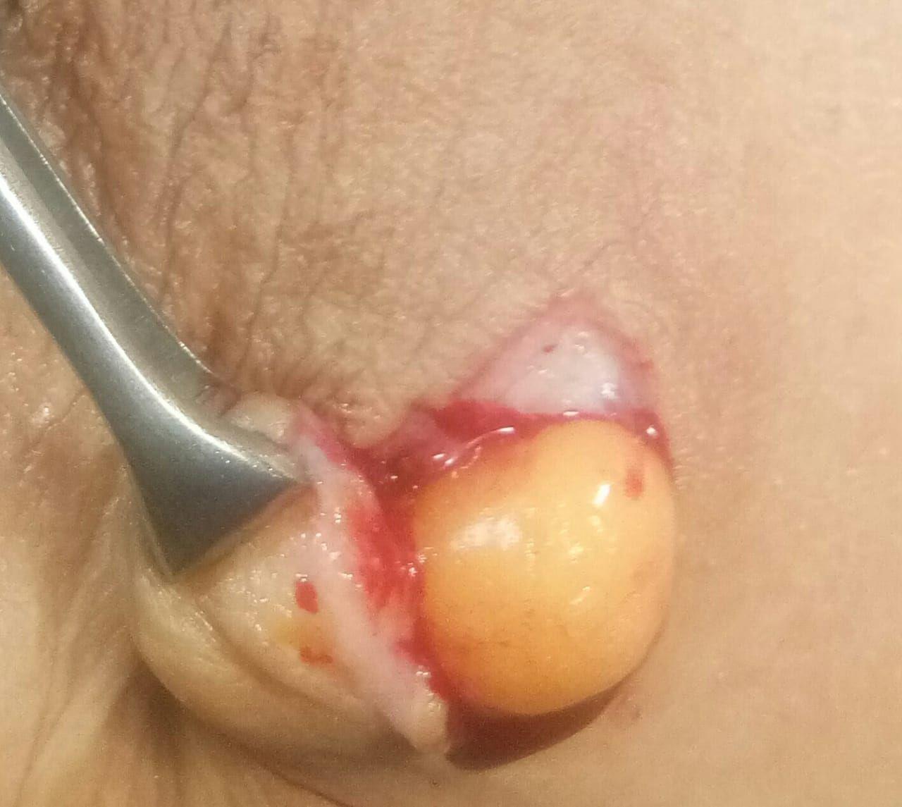Rare case of Giant lipoma of breast operated in SDH Pattan