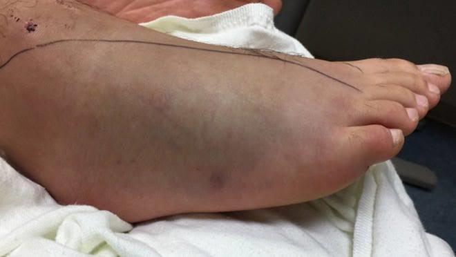 Woman Bitten by Snake in Bandipora, Referred to Srinagar Amid Concerns Over Lack of Anti-Venom